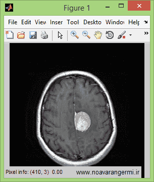 تصویر matlab-brain-tumotr-Fuzzy-logic-mamdani_11632_4 تصویر matlab-brain-tumotr-Fuzzy-logic-mamdani_11632_4 تشخیص تومور مغزی با منطق فازی و روش ممدانی با متلب