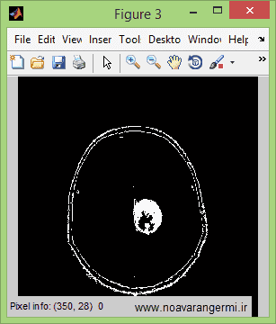تصویر matlab-brain-tumotr-Fuzzy-logic-mamdani_11632_5 تصویر matlab-brain-tumotr-Fuzzy-logic-mamdani_11632_5 تشخیص تومور مغزی با منطق فازی و روش ممدانی با متلب