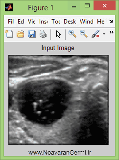 تصویر matlab-thyroid_13789_1 تصویر matlab-thyroid_13789_1 تشخیص غده تیروئید با پردازش تصویر با متلب