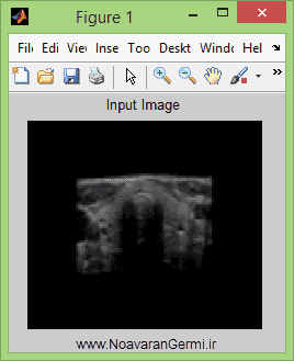 تصویر matlab-thyroid_13789_3 تصویر matlab-thyroid_13789_3 تشخیص غده تیروئید با پردازش تصویر با متلب