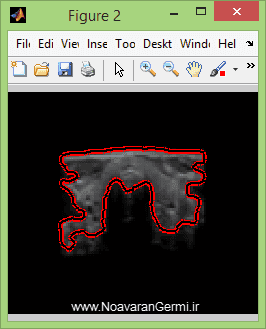 تصویر matlab-thyroid_13789_4 تصویر matlab-thyroid_13789_4 تشخیص غده تیروئید با پردازش تصویر با متلب