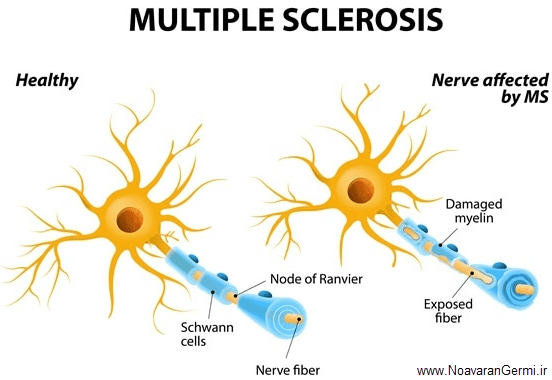 تصویر translate-multiple-sclerosis_23148 تصویر translate-multiple-sclerosis_23148 رویکرد تکاملی تفاضلی برای رده بندی ضایعات فلج چند گانه